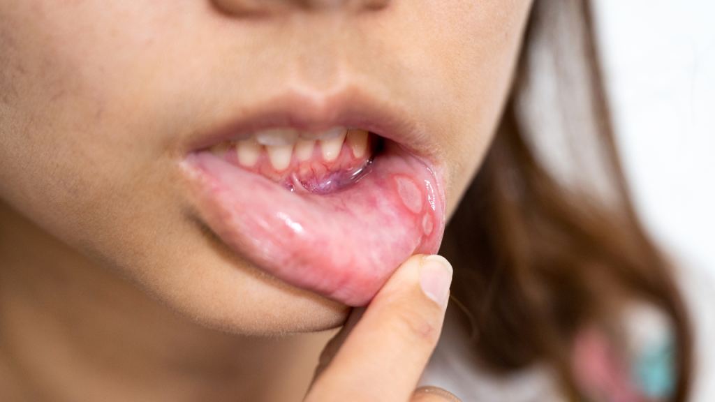 rak usne supljine