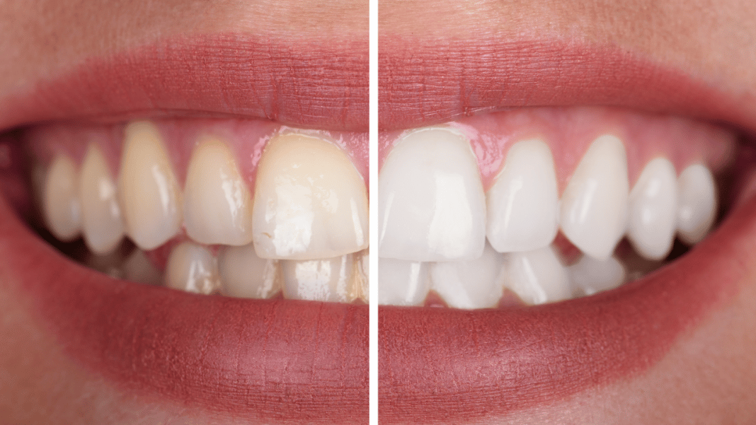 Metode izbjeljivanja zubi