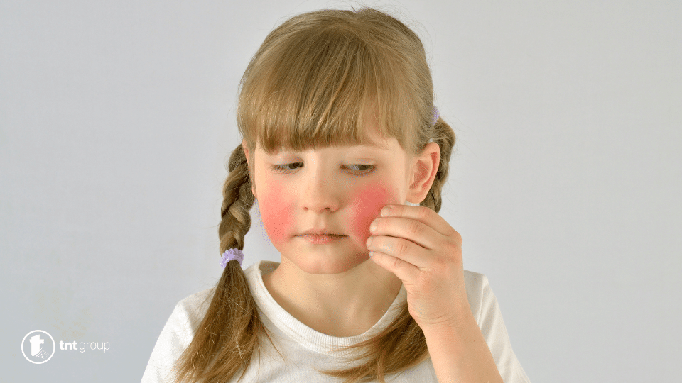 Simptomi dermatitisa kod djece
