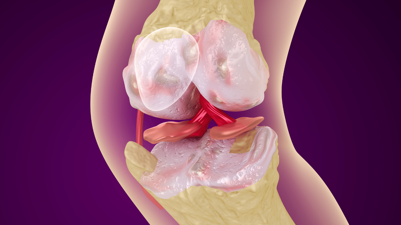 Osteoporoza