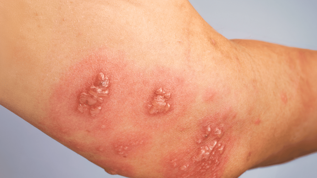 Herpes zoster prirodno liječenje