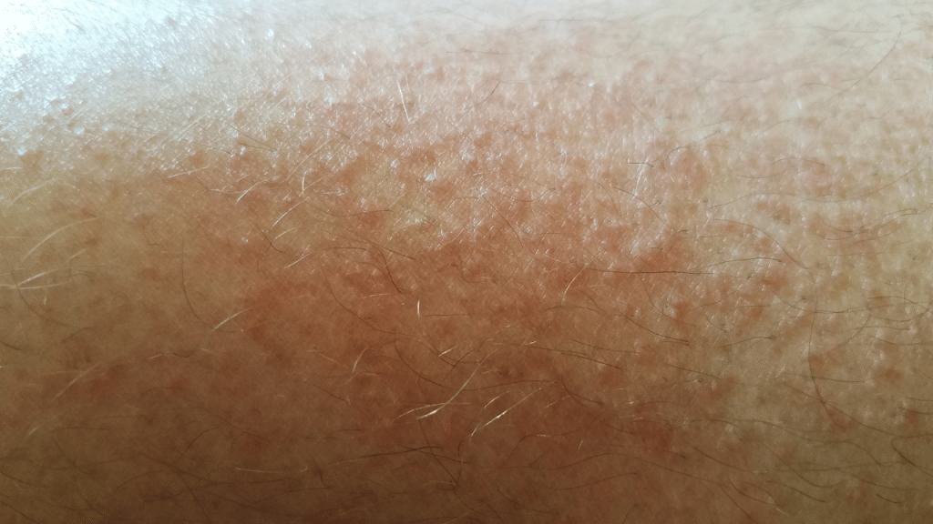 Herpes zoster prirodno liječenje