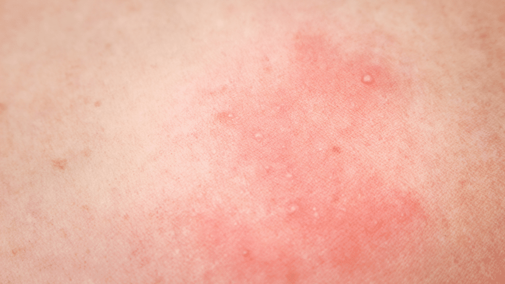 Herpes zoster prirodno liječenje